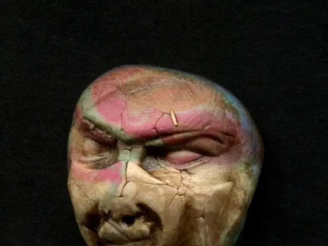 Nevus raro diagnosticato a Nizhny Novgorod: condizione cutanea rara identificata